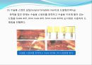 임플란트(Implant)와 관교의치의 개념 및 용어정리.ppt 15페이지