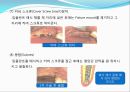 임플란트(Implant)와 관교의치의 개념 및 용어정리.ppt 18페이지