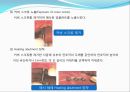 임플란트(Implant)와 관교의치의 개념 및 용어정리.ppt 20페이지