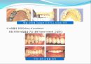 임플란트(Implant)와 관교의치의 개념 및 용어정리.ppt 26페이지