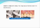 임플란트(Implant)와 관교의치의 개념 및 용어정리.ppt 27페이지