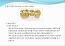 임플란트(Implant)와 관교의치의 개념 및 용어정리.ppt 30페이지