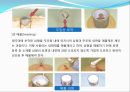 임플란트(Implant)와 관교의치의 개념 및 용어정리.ppt 42페이지