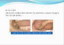 임플란트(Implant)와 관교의치의 개념 및 용어정리.ppt 49페이지