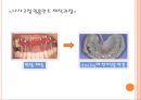 임플란트 제작과정.ppt 8페이지