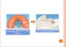 임플란트 제작과정.ppt 18페이지