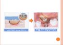 임플란트 제작과정.ppt 22페이지
