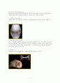 반월상연골제거수술(meniscectomy) 11페이지