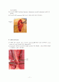 간절제술(liver lobectomy)술기 및 수술간호 17페이지