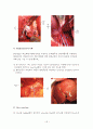 간절제술(liver lobectomy)술기 및 수술간호 19페이지