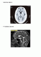 뇌수막염 case (뇌수막염의 정의, 뇌수막염의 원인, 뇌수막염의 증상, 뇌수막염의 진단검사 방법, 뇌수막염의 예방 방법, 뇌수막염 환자의 CASE) 6페이지