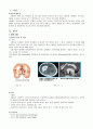 NSICU(신경외과중환자실) S-ICH on Lt B.G Spontaneous IntraCellural hemorrhage on Lt. Basal Ganglial (고혈압성 뇌출혈, 기저핵부분) 고혈압성 자발성 뇌내출혈 케이스 스터디 Case study 2페이지