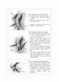 Gallbladder stone Laparoscopic cholecystectomy 담석증 복강경 담낭 절제술 (GB stone gallbladder stone 담석증) case study 13페이지