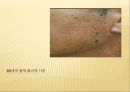 노인질병의 예방 (노인 질병, 뇌졸중, 치매, 당뇨병, 고혈압, 지루 각화증).PPT자료 33페이지