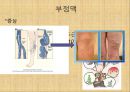 [혈압 치료 방안] 운동 중 혈압의 변화 원인과 문제점 및 다양한 혈압 관련 질환과 치료방안 17페이지