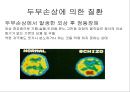 뇌종양종류 및 증상,양성종양 VS 악성종양,뇌종양 수술 방법,뇌종양에 좋은 음식,뇌농양,두부손상,두부손상 응급처치,두부손상에 의한 질환 22페이지
