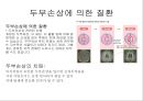 뇌종양종류 및 증상,양성종양 VS 악성종양,뇌종양 수술 방법,뇌종양에 좋은 음식,뇌농양,두부손상,두부손상 응급처치,두부손상에 의한 질환 23페이지