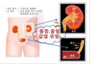 비뇨기계 질환과 간호 (신장 결석, 요관결석, 요로감염, 신장암, 방광염, 방광암, 과민성 방광, 요실금, 방광 결석, 방광요관역류, 전립선 비대증, 전립선염, 전립선 암, 음낭 질환, 고환암, 요도 협착).pptx 6페이지