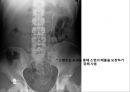 비뇨기계 질환과 간호 (신장 결석, 요관결석, 요로감염, 신장암, 방광염, 방광암, 과민성 방광, 요실금, 방광 결석, 방광요관역류, 전립선 비대증, 전립선염, 전립선 암, 음낭 질환, 고환암, 요도 협착).pptx 10페이지