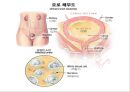 비뇨기계 질환과 간호 (신장 결석, 요관결석, 요로감염, 신장암, 방광염, 방광암, 과민성 방광, 요실금, 방광 결석, 방광요관역류, 전립선 비대증, 전립선염, 전립선 암, 음낭 질환, 고환암, 요도 협착).pptx 21페이지