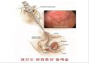 비뇨기계 질환과 간호 (신장 결석, 요관결석, 요로감염, 신장암, 방광염, 방광암, 과민성 방광, 요실금, 방광 결석, 방광요관역류, 전립선 비대증, 전립선염, 전립선 암, 음낭 질환, 고환암, 요도 협착).pptx 46페이지
