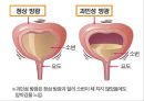 비뇨기계 질환과 간호 (신장 결석, 요관결석, 요로감염, 신장암, 방광염, 방광암, 과민성 방광, 요실금, 방광 결석, 방광요관역류, 전립선 비대증, 전립선염, 전립선 암, 음낭 질환, 고환암, 요도 협착).pptx 48페이지