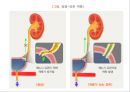 비뇨기계 질환과 간호 (신장 결석, 요관결석, 요로감염, 신장암, 방광염, 방광암, 과민성 방광, 요실금, 방광 결석, 방광요관역류, 전립선 비대증, 전립선염, 전립선 암, 음낭 질환, 고환암, 요도 협착).pptx 68페이지