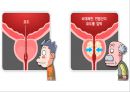 비뇨기계 질환과 간호 (신장 결석, 요관결석, 요로감염, 신장암, 방광염, 방광암, 과민성 방광, 요실금, 방광 결석, 방광요관역류, 전립선 비대증, 전립선염, 전립선 암, 음낭 질환, 고환암, 요도 협착).pptx 78페이지