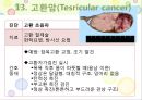 비뇨기계 질환과 간호 (신장 결석, 요관결석, 요로감염, 신장암, 방광염, 방광암, 과민성 방광, 요실금, 방광 결석, 방광요관역류, 전립선 비대증, 전립선염, 전립선 암, 음낭 질환, 고환암, 요도 협착).pptx 87페이지