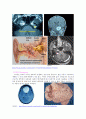 Brain _ tumor 4페이지