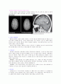 Brain _ tumor 5페이지