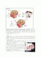 Brain _ tumor 8페이지