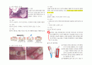 비가역성 치수염 (치수염의 원인, 치수염의 종류, 치수염 예방방법) 2페이지