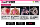  직업병, 진폐증(PNEUMOCONIOSIS).pptx 9페이지