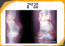 골다공증(osteoporosis)에 관하여(운동 및 식이지침).pptx 6페이지