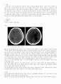 Subdural hemorrhage  3페이지