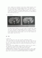 Cushing`s Syndrome 쿠싱 증후군 문헌고찰, 간호 9페이지