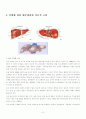 간암 케이스 스터디 casestudy - 간세포 암종 (Hepatocellular Carcinoma) 사례연구 : Dx : Multiple HCC with rupture 2페이지