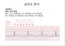 심전도 (심전도 분석, 부정맥).pptx 17페이지