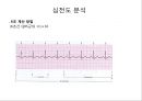 심전도 (심전도 분석, 부정맥).pptx 18페이지