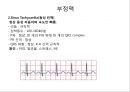 심전도 (심전도 분석, 부정맥).pptx 20페이지