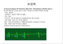 심전도 (심전도 분석, 부정맥).pptx 31페이지