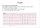 심전도 (심전도 분석, 부정맥).pptx 35페이지