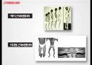 지체 및 건강장애,장애인 특수교육법,지체 장애의 원인(뇌성마비,이분척추,골형성 부전증),건강장애의 원인(경련장애,외상성 뇌손상,소아암,신장장애) 16페이지