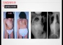 지체 및 건강장애,장애인 특수교육법,지체 장애의 원인(뇌성마비,이분척추,골형성 부전증),건강장애의 원인(경련장애,외상성 뇌손상,소아암,신장장애) 22페이지