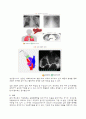 폐부종(Pulmonary edema) 케이스 레포트 입니다. 4페이지