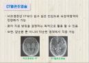뇌졸중에 대하여 12페이지