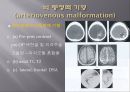 Brain CT에 관한 PPT 8페이지