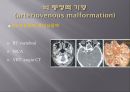 Brain CT에 관한 PPT 11페이지