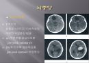 Brain CT에 관한 PPT 20페이지